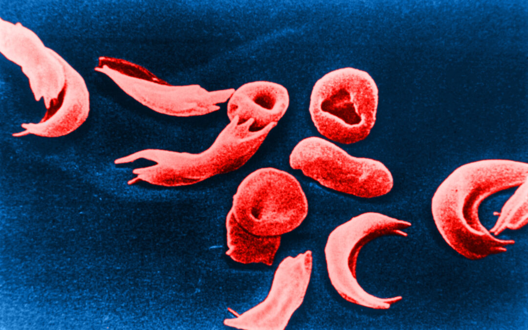 CLY-124: A First-in-Class Globin-Switching Oral Medicine for the Treatment of Sickle Cell Disease